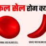 What is sickle cell disease सिकल सेल रोग क्या है